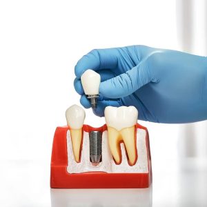 Implant Dentistry in London, ON