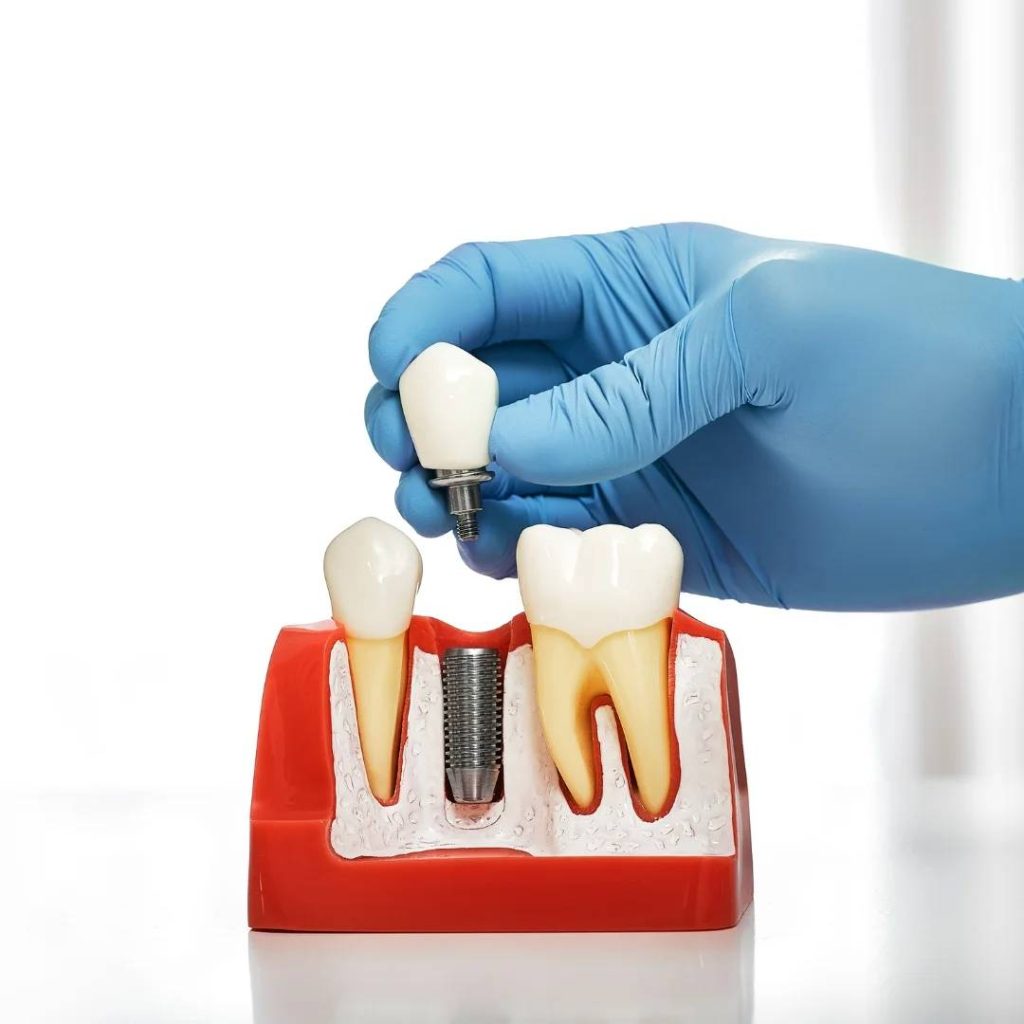 Gloved hand holding a dental implant crown above a model displaying three teeth with an implant fixture in the center